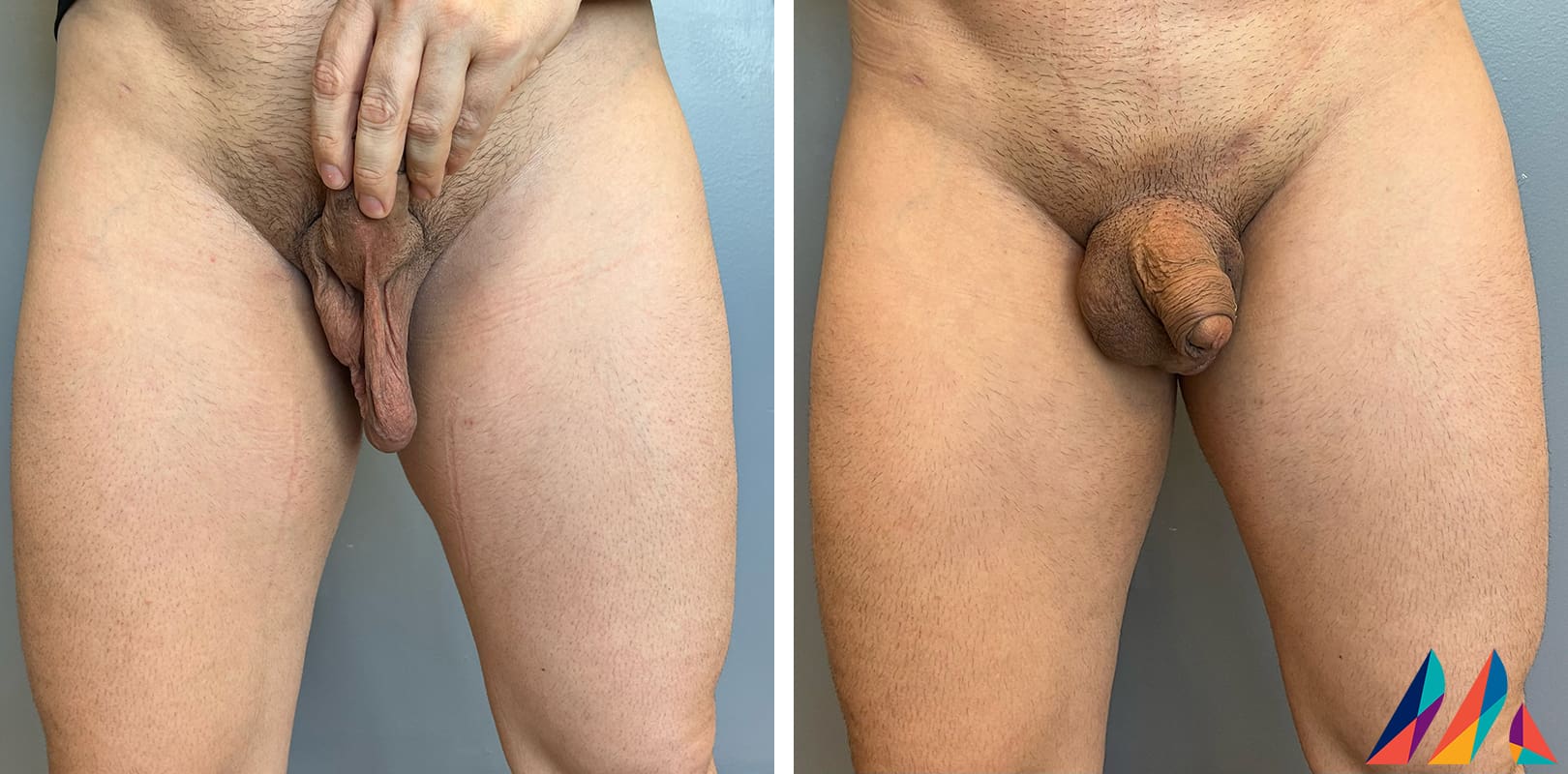 Scrotal Lift Before & After Image