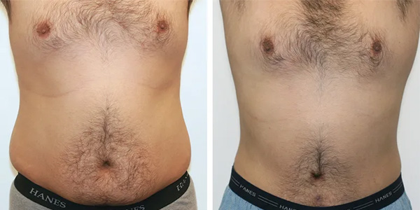 Abdominoplasty Before & After Image