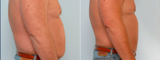 Abdominoplasty Before & After Image