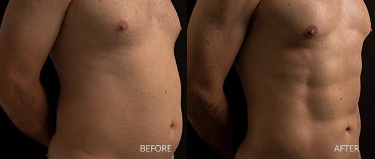 Abdominoplasty Before & After Image