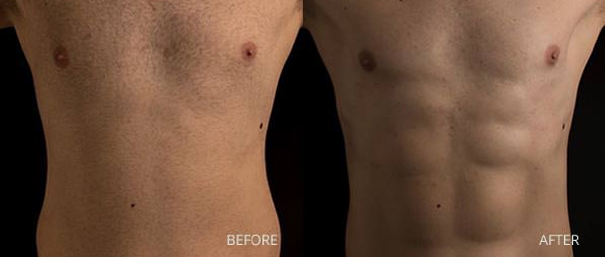 Abdominoplasty Before & After Image