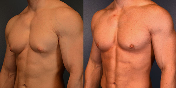 Gynecomastia Before & After Image