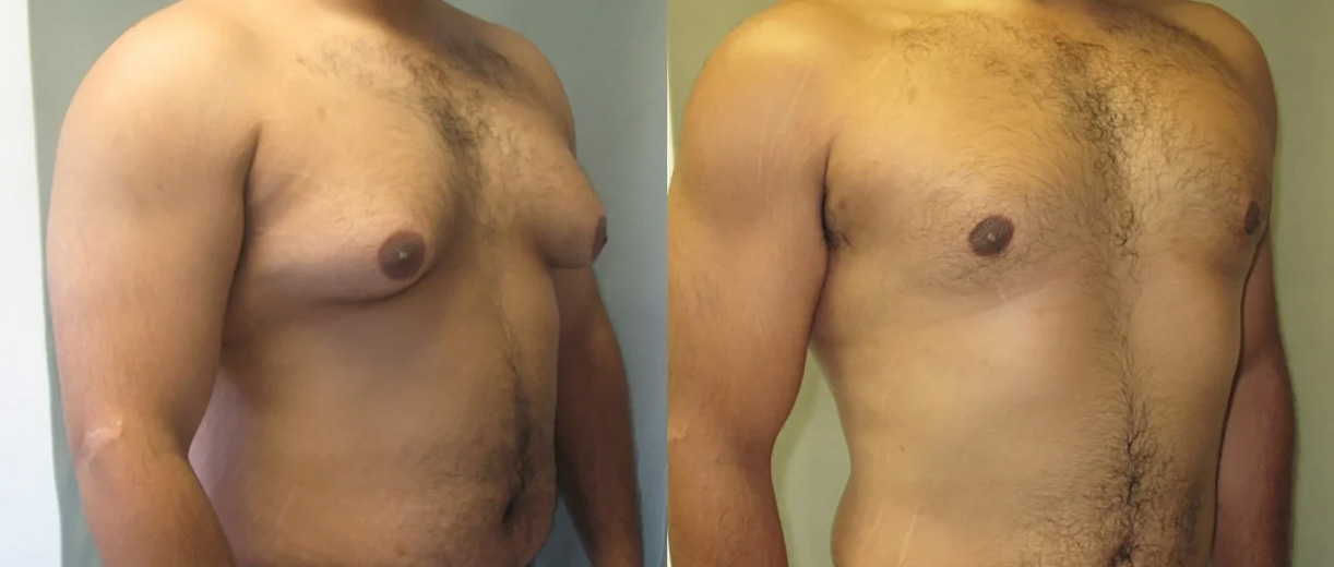 Gynecomastia Before & After Image