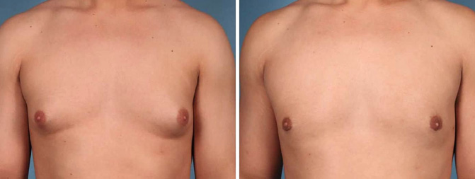 Gynecomastia Before & After Image