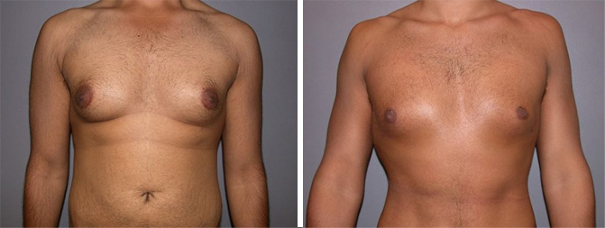 Gynecomastia Before & After Image