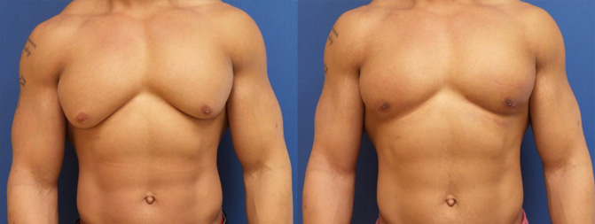 Gynecomastia Before & After Image