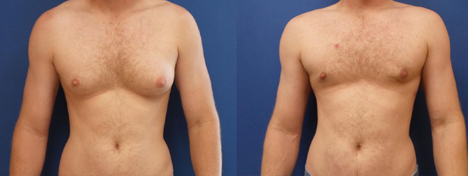 Gynecomastia Before & After Image